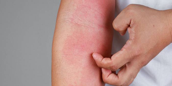 Uyuz vakalarında pandemi artışı