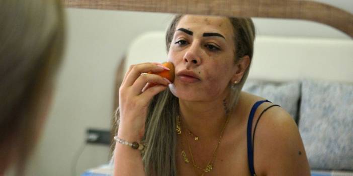 Güzellik merkezine gitti, yüzünde yanıklarla döndü