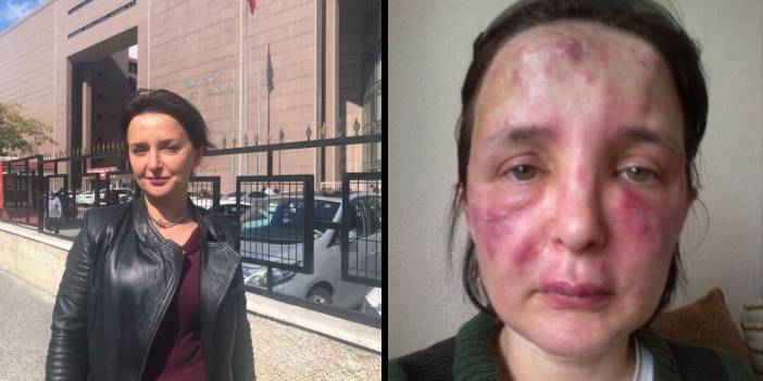 Dolgu yaptığı kadının yüzünde kalıcı hasar bırakan sahte doktora hapis cezası