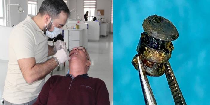 15 yıl sonra yanağında metal parçası olduğunu öğrendi