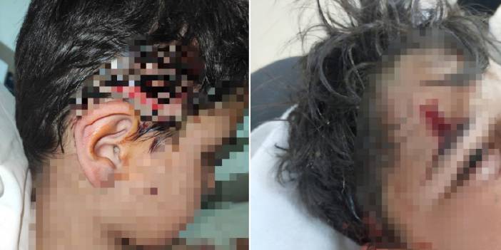 Okul yolunda 8 köpek saldırdı: Vücuduna 80 dikiş atıldı