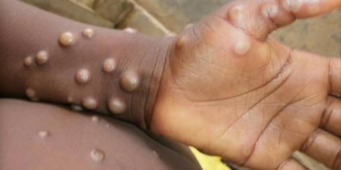 Finlandiya'da ilk maymun çiçeği vakası