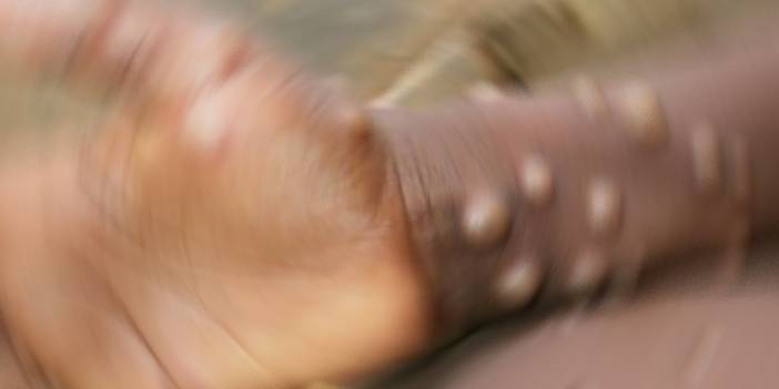 DSÖ'den 'maymun çiçeği virüsü' açıklaması: Kanıt yok