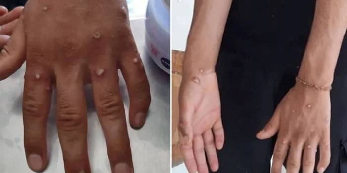 Maymun çiçeğinden şüphe edilen 4 kişinin testi negatif