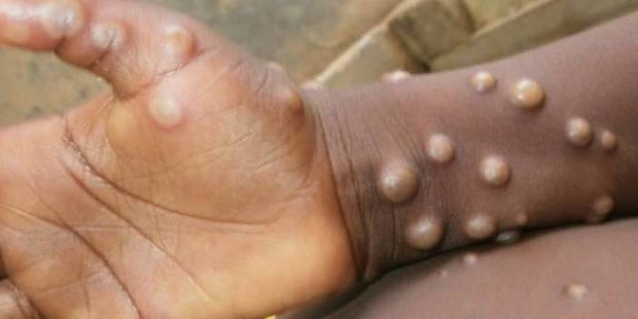 Meksika'da ilk maymun çiçeği vakası hastaneden kaçtı