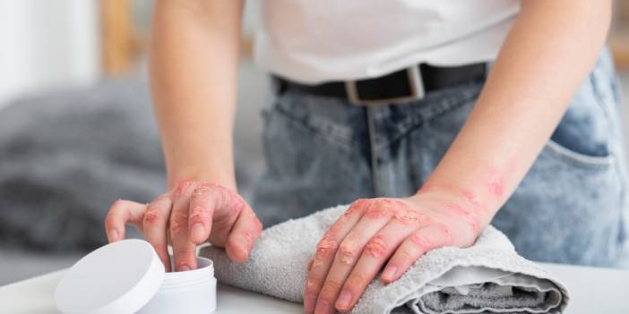 Sedef tansiyonu tetikliyor