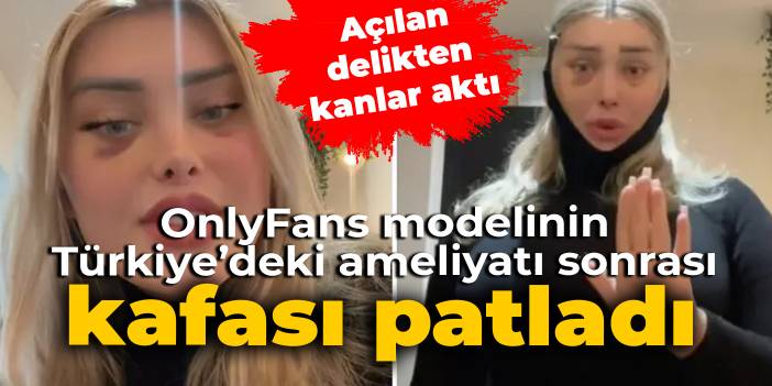 Onlyfans modelinin Türkiye'deki ameliyatı sonrası kafası patladı