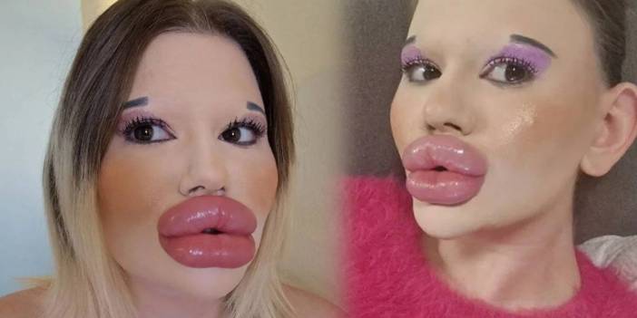 Doktorların ölüm uyarılarını hiçe sayıyor: Dudak estetiğine dudak uçuklatan servet